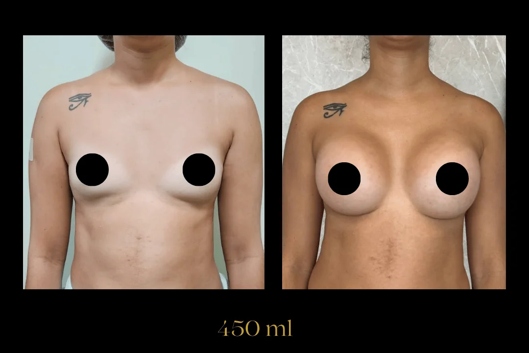 Caso 11 — antes e depois