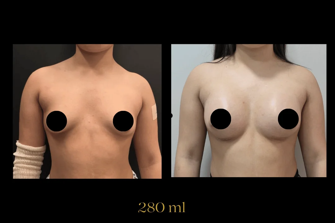 Caso 13 — antes e depois