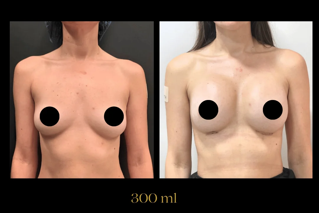 Caso 14 — antes e depois