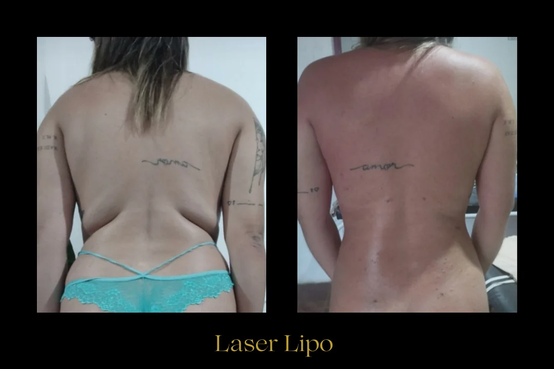 Caso 1 — laser de retração de pele com lipoaspiração local (costas e flancos)