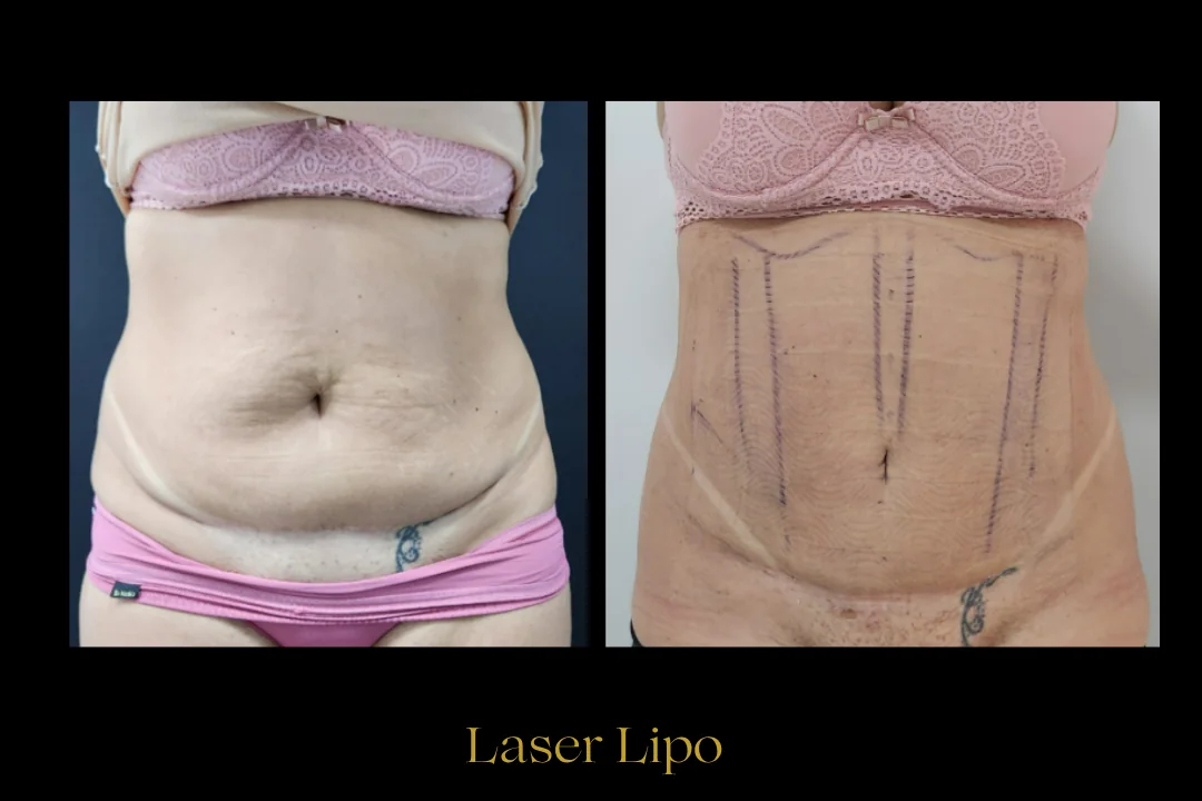 Caso 2 — laser de retração de pele com lipoaspiração local (abdômen)