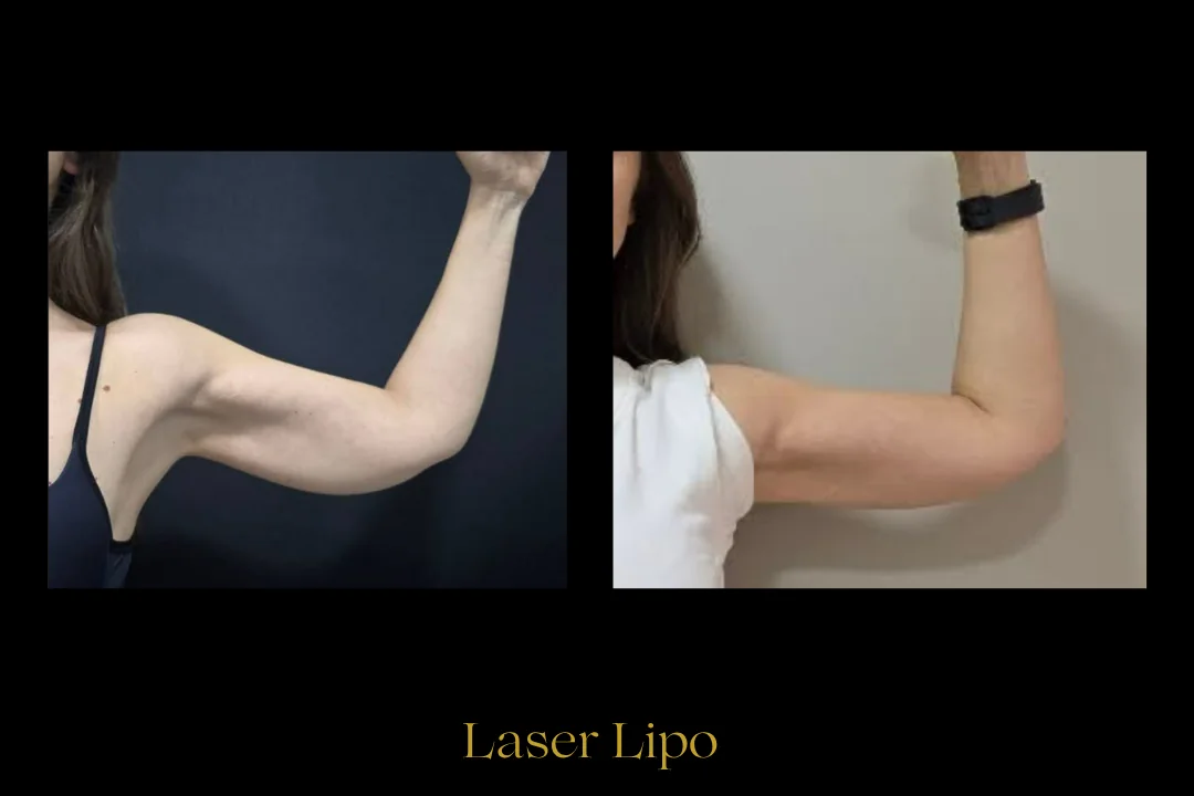Caso 3 — laser de retração de pele com lipoaspiração local (braço)