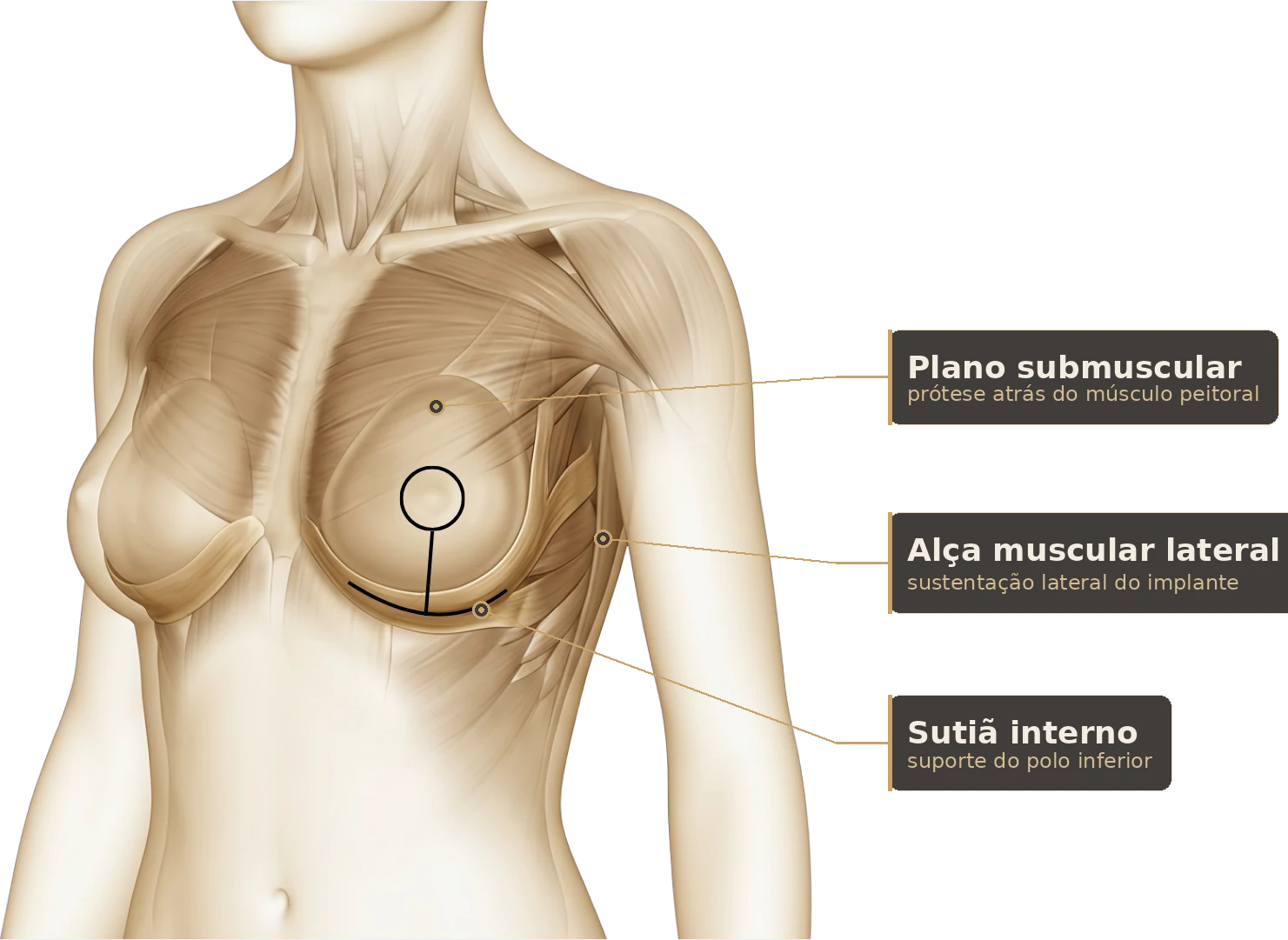 Modelo anatômico da mastopexia com prótese: plano submuscular, alça muscular lateral e sutiã interno